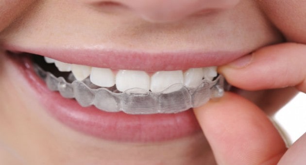 aparelho dentario movel infantil 2 min