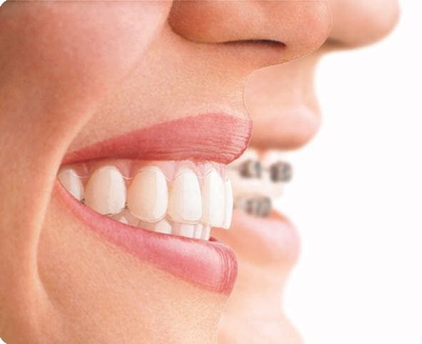 aparelho dentario