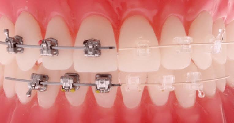 aparelho ortodontico estetico life sorrisos sp min