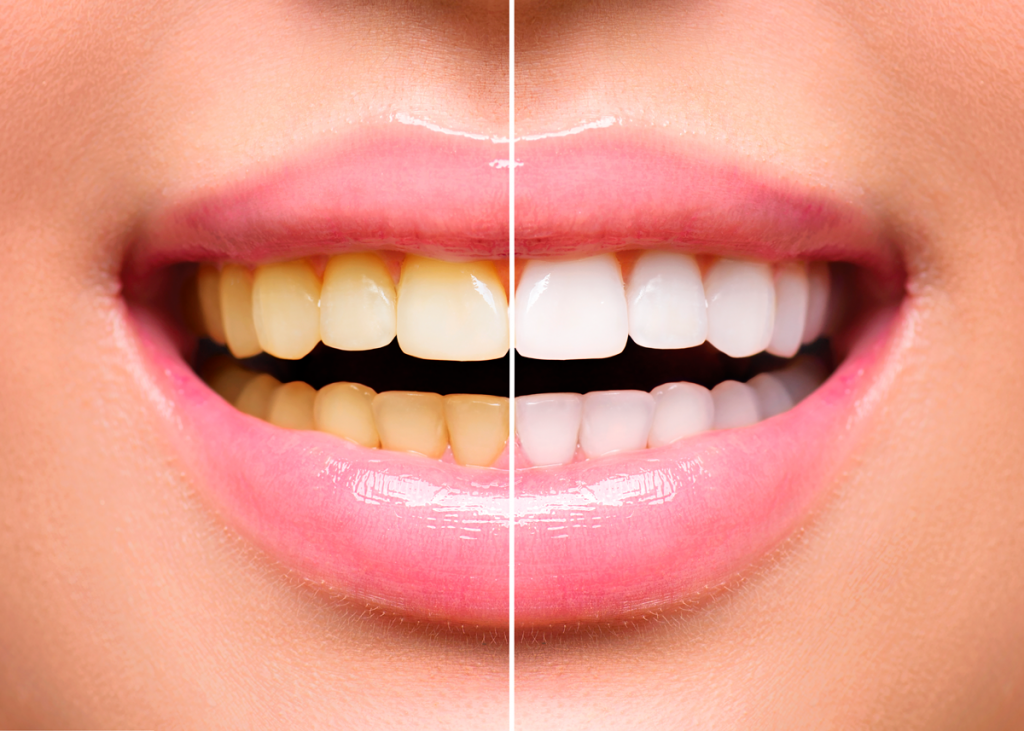 clareamento dental antes e depois 1024x731