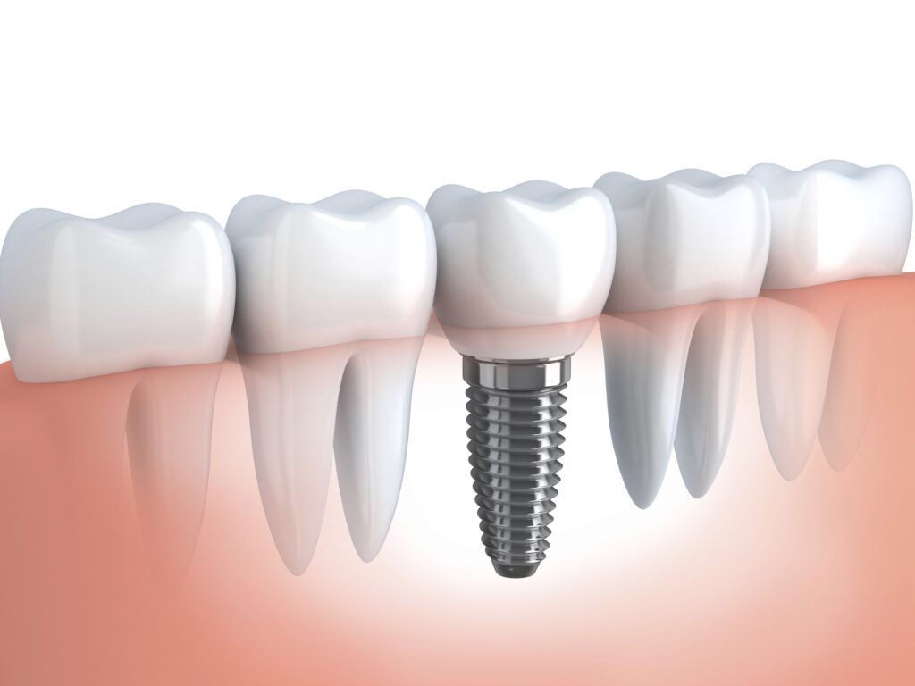 clinica de implante dentario min