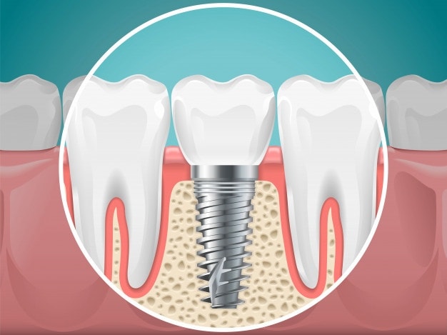 ilustracoes de estomatologia implantes dentarios e dentes saudaveis vector dente de saude e estomatologia de implante instalacao de dentista e fixacao 80590 2811 min