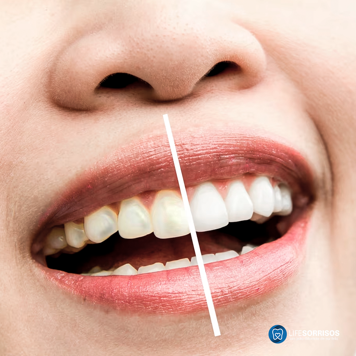 imperfeição dos dentes