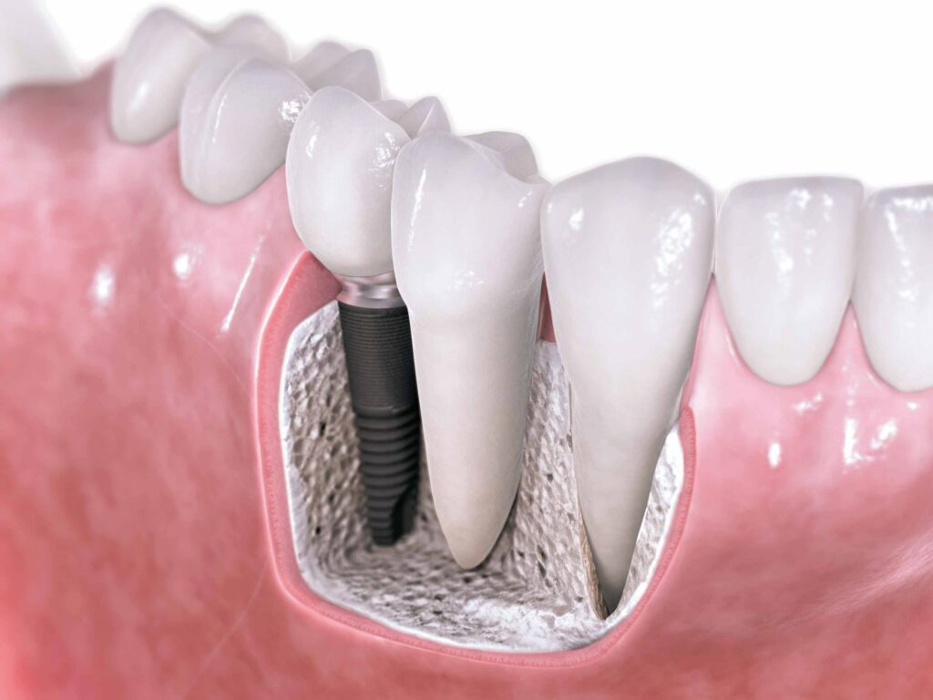 implante de dente 2 min