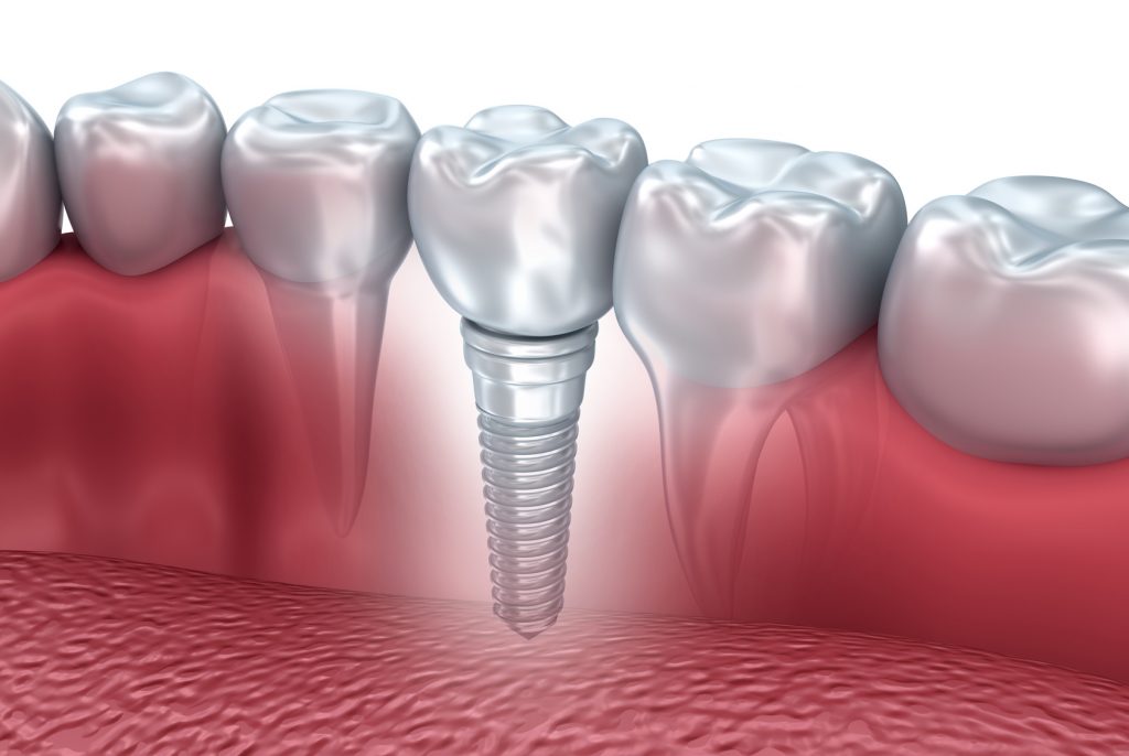 implante dentario life sorrisos min