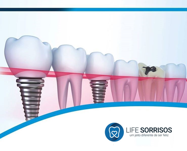 implantes dentarios 2 min