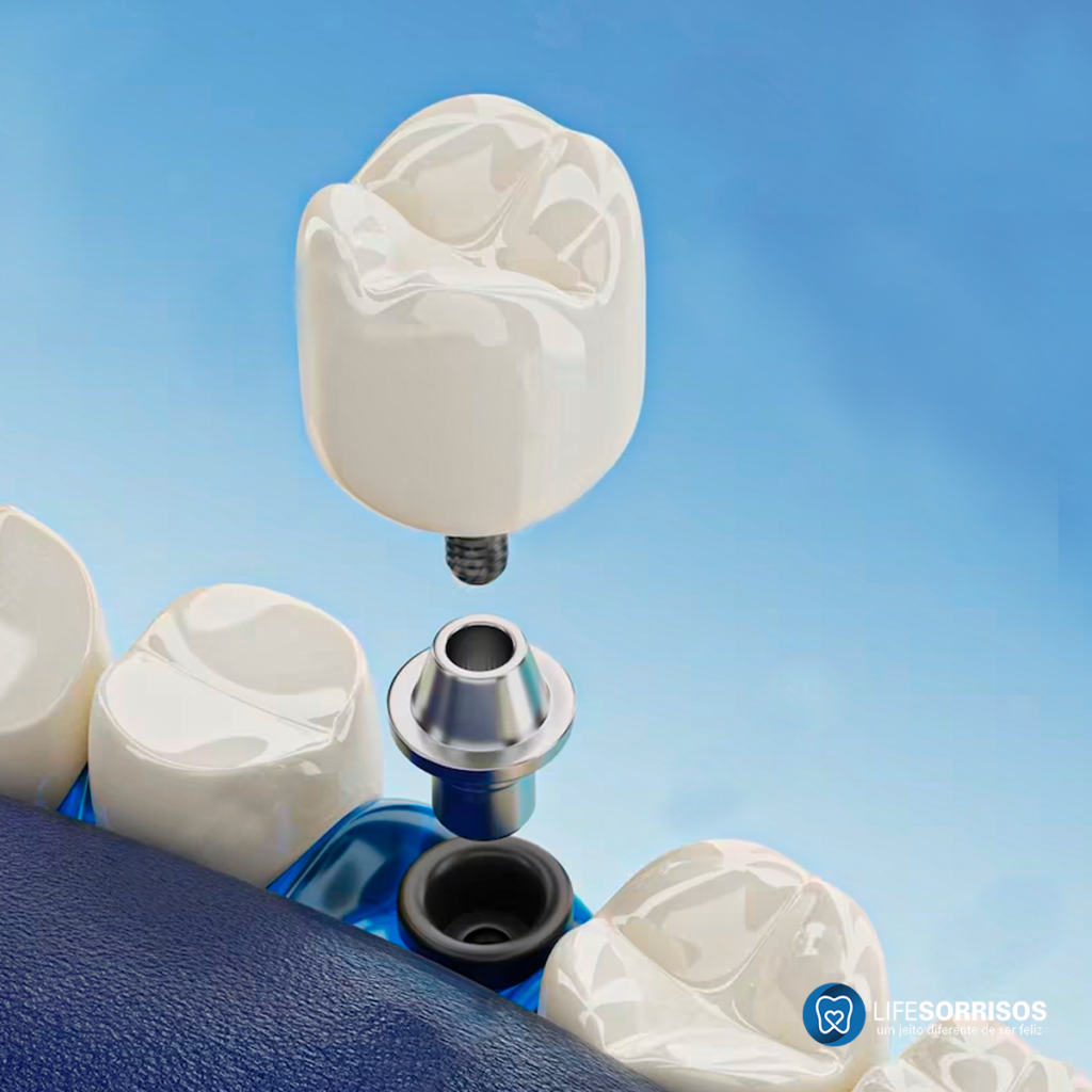 ja saio da cirurgia com as próteses dentárias