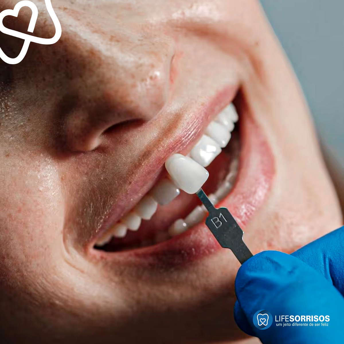 precisa desgastar e deixar os dentes pontiagudos para colocar lentes de contato