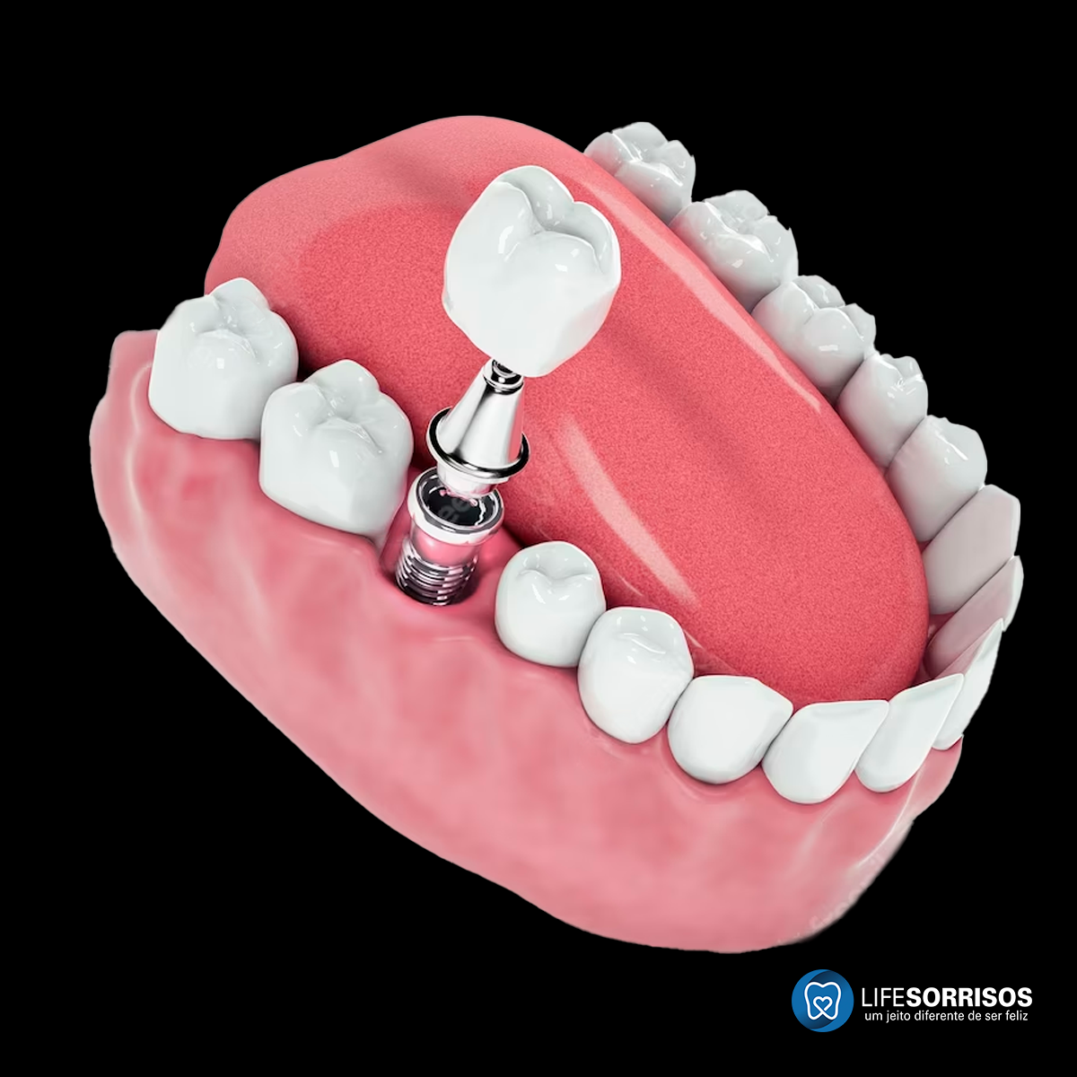 qual a diferença entre implante e prótese dentária