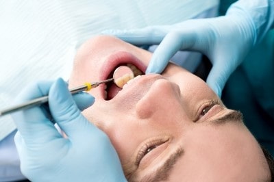 tartaro nos dentes min