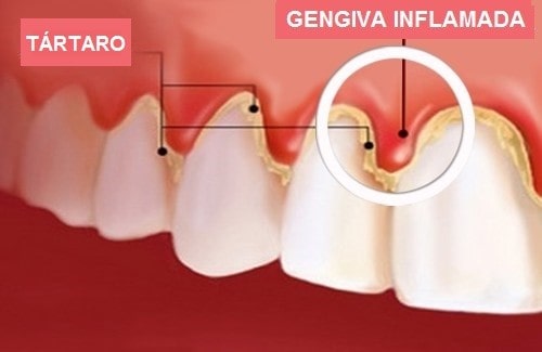 tratamento para gengivite 2 min