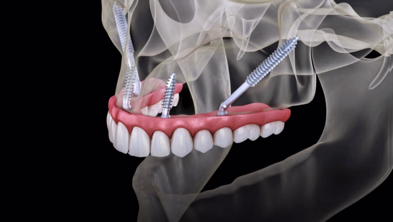 implante zogmatico ramos odontologia copiar